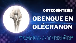 Osteosíntesis  Obenque en olécranon quotBanda a tensiónquot [upl. by Iggep821]