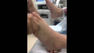 Pre and Postop Tarsal Coalition Surgery Intraoperarive Video SFISM [upl. by Sirromal]