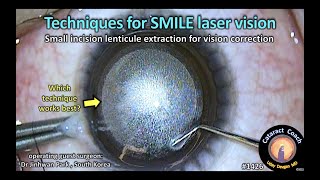 CataractCoach 1426 techniques for SMILE laser vision surgery [upl. by Aysan]