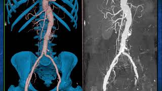 CTA of the Renal Arteries What You Need to Know  Part 1 [upl. by Borek]