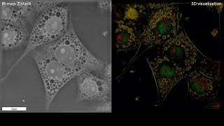 Lysosomal Storage Disorders LSD and 3D microscope [upl. by Ob202]