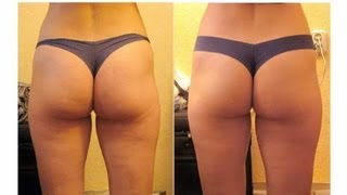 Cellulite Treatments Tested  Cellulite Factor Review [upl. by Zigmund]