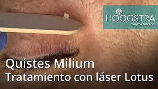 Quistes Milium  Tratamiento con láser Lotus 20219 [upl. by Slotnick]