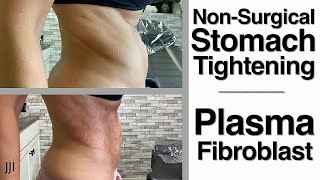 Non Surgical Stomach Tightening  Plasma Fibroblast [upl. by Nhar]