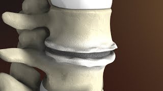 Degenerative Disc Disease Spondylosis explained by Spine Surgeon Dr Jessica Shellock Plano TX [upl. by Codd]