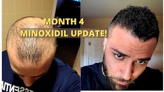 Month 4 ROGAINE RESULTS Minoxidil  Safflower oil [upl. by Allimac]