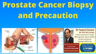 BIOPSY for PROSTATE CANCER Diagnosis  DrProfSantosh Kumar PGI [upl. by Hardi731]