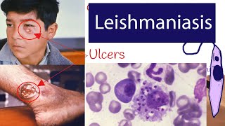 Leishmaniasis  Symptoms and Treatment of Leishmaniasis Explained under 3 minutes [upl. by Heilman]