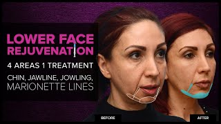 Lower Face Rejuvenation Chin Jawline amp Jowls With Dermal Fillers at Mabrie Facial Institute [upl. by Lemert]