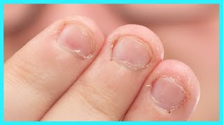 Dual Forms amp Polygel for BITTEN NAILS  Will it work Anna Nails Transformation [upl. by Mikah66]