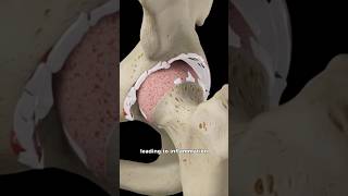 Osteoarthritis of Hip joint shorts 3danimation animation [upl. by Esikram57]