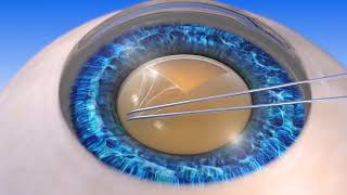 Is LASER Cataract Surgery Better than Traditional [upl. by Aeriel]