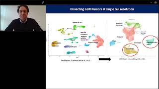 Multivalent RNA CART cell for malignant glioma [upl. by Wrightson]