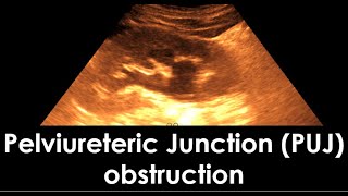 Pelviureteric Junction PUJ obstruction  dilatation of the pelvicaliceal system  Hydronephrosis [upl. by Nasaj]