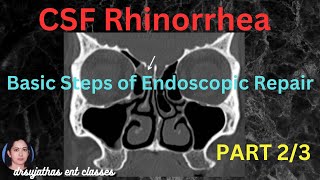 235CSF Rhinorrhea Part 23 CSF Rhinorrhea Treatment surgeryeducation dentallectures [upl. by Neema116]