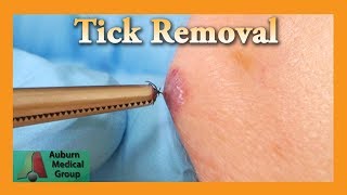 Dead Tick Removal  Auburn Medical Group [upl. by Animahs]