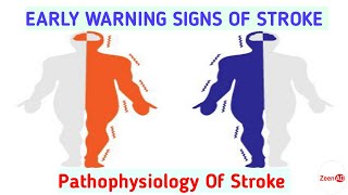 StrokeEARLY WARNING SIGNS OF STROKEPathophysiology Of StrokeMedications In Ischemic Stroke [upl. by Yllop]