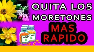 Como quitar los moretones o Hematomas MAS RAPIDO [upl. by Cowen]