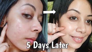 How I Repaired My Skin Barrier in 5 Days At Home Affordable Products skincare [upl. by Micki]