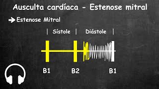 Ausculta cardiaca estenose mitral e insuficiencia mitral [upl. by Fogel413]