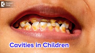 CAVITIES IN CHILDREN Tooth Decay Caries or Cavities in ChildrenDrLahari ASR  Doctors Circle [upl. by Sadoc]