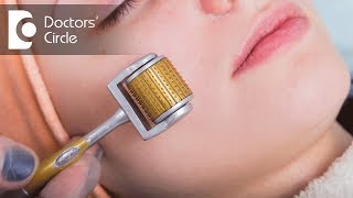 Derma Roller for Acne Scars Treatment  Microneedling [upl. by Neerbas466]