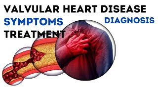 Valvular heart disease  symptoms causes treatment [upl. by Strander]