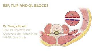 ESP erector spinae plane TLIPthoracolumbar interfascial plane AND QL BLOCKS [upl. by Nosiaj]