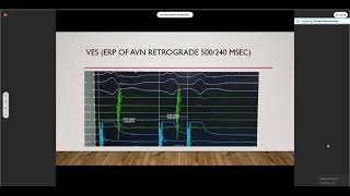 AVNRT Ablation Dr Ahmed Abdelmoniem [upl. by Jenkins]