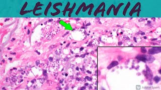 Leishmaniasis Leishmania Infection 5Minute Pathology Pearls ‪Dermatology Dermatopathology [upl. by Ecirahc]