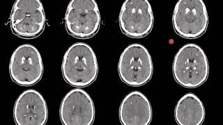 Familial Idiopathic Basal Ganglia Calcification FIBGC [upl. by Enirroc]