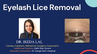 Eyelash Lice Removal by Dr Ikeda Lal  Delhi Eye Centre [upl. by Jedthus209]