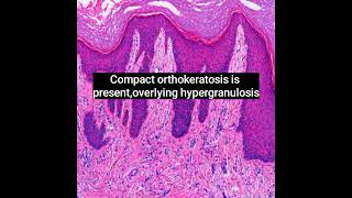 Histopathology of Lichen Simplex Chronicus dermpath dermatopathology skin shorts [upl. by Karly588]