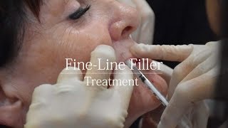 Fine Line Dermal Filler  treatment video [upl. by Scammon29]