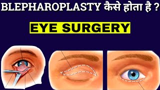 How Blepharoplasty Is Performed  Blepharoplasty  Eyelid Surgery Animation [upl. by Alyk]