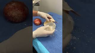 Calcified capsular contracture of breast implants 30 Million views on TikTok [upl. by Devan88]