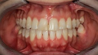 Invisalign Time Lapse [upl. by Jonna]