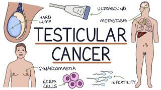 Understanding Testicular Cancer [upl. by Yadseut944]