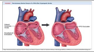 Paradoxical embolism pathology mbbs [upl. by Reste]