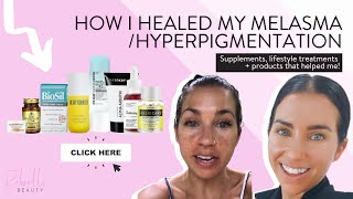 How I Healed My MelasmaHyperpigmentation 2021 Updates Products Supplements and Treatments [upl. by Alpheus]