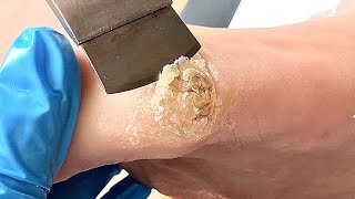 Callus removal from feetampFoot scraping dead skin【Xiao Yan pedicure】stress 46 [upl. by Sholeen]