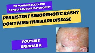 Persistent seborrhoeic rashdont miss Letterer Siwe disease rash newbornrash dermatology [upl. by Egas247]