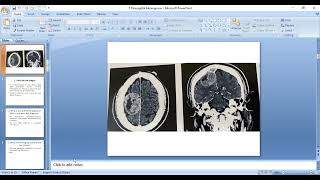 5 Parasagittal meningioma [upl. by Cralg]