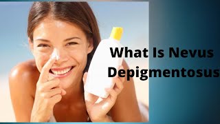 What Is Nevus Depigmentosus [upl. by Kuth630]