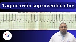 ¿Palpitaciones y mareos 😵 ¡No lo ignores La Taquicardia Supraventricular puede ser peligrosa [upl. by Ilario]