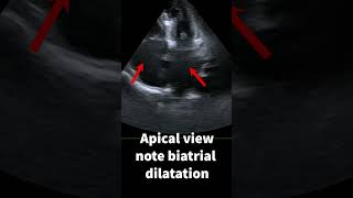 Restrictive cardiomyopathy [upl. by Enneibaf]