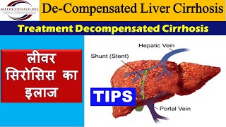 Decompensated liver cirrhosis  Decompensated liver disease [upl. by Carvey]