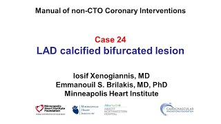 Case 24 PCI Manual LAD calcified bifurcation lesion [upl. by Chatwin]