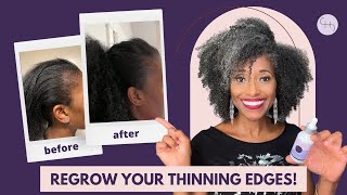 The Ultimate Guide to Regrowing Thinning Hair Edges [upl. by Aseefan]