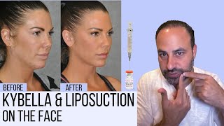 What You Need to Know About Liposuction amp Kybella in the Face [upl. by Japha]